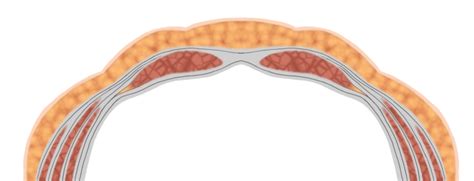 abdomac|Wechsel eines Abdominellen Vakuumsaugverbands beim offenen .